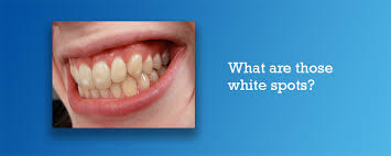 6 Unexpected Causes Of White Spots On Teeth Carifree