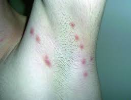La picazón puede continuar por dos semanas o más después de iniciado el tratamiento, pero. Sarna Trastornos Dermatologicos Manual Msd Version Para Profesionales