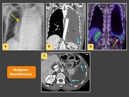 13.08.2009 · chest x ray is the initial screening test for the mesothelioma like all other the chest diseases. Epos Trade