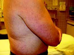 Although many people are bitten by mosquitos that carry west nile virus, most do not know they've been exposed. The Rash Of West Nile Virus Infection Cmaj