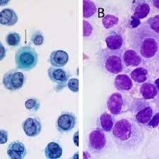 In addition, pleural fluid cytology is difficult in the diagnosis . Mesothelioma In A Pleural Fluid Specimen Atypical Mesothelial Cells Download Scientific Diagram