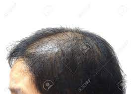 Asian hair loss is three times less common than in caucasians. Asian Female Head With Hair Loss Stock Photo Picture And Royalty Free Image Image 62127889