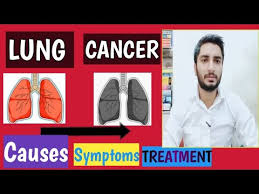 Stanifer explains that, in rare cases of lung cancer, patients may experience hypercalcemia — heightened levels of calcium in the body — which can manifest in physical symptoms such as chronic. Lung Cancer Causes Symptoms Types And Treatment In Hindi Lung Cancer Ka Ilaj Youtube