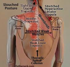 Pin On Effects Of Bad Posture