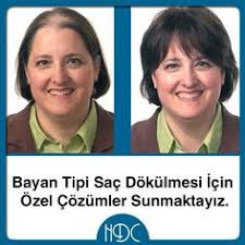 Hdc Protez Sac On Instagram Bayan Tipi Sac Dokulmesi Erkeklerdeki Gibi Tepe Bolgenin Tamamen Dokulmesi Olarak Gorulmez Bayanl Instagram Posts Instagram Post