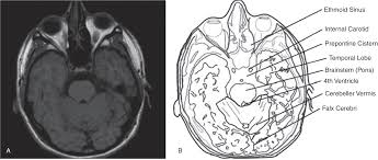 Resonance imaging (mri) of the brain was obtained due to neurological deficits. Mri Of The Brain Chapter 39 Clinical Emergency Radiology