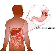 Typically, cancer signs and symptoms first appear when the cancerous tumor or mass has grown large enough that it begins to push against nearby organs and tissue, blood vessels, and nerves. Gastric Cancer Cancerquest