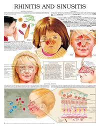 Rhinitis And Sinusitis Sinusitis Medical Knowledge Students Health