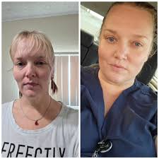 Do anyone get bad headaches after surgery