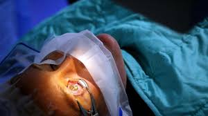 Eine wichtige voraussetzung um die augen zu lasern besteht in dem grad der sehschwäche. Experten Warnen Vor Augen Op Im Ausland Wissen