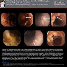 Image result for Colonoscopy in GI Bleeding
