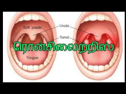 Mymemory, world's largest translation memory. Sore Throat Meaning In Tamil