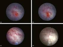Nd:YAG Laser - an overview | ScienceDirect Topics
