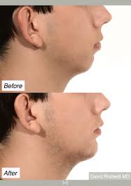 Chin Implants |Enhance Your Facial Proportion