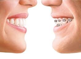 Behel fashion permanen protect ini memiliki model lucu dan imut sist. Ingat Ya Behel Itu Bukan Fashion Dental Id