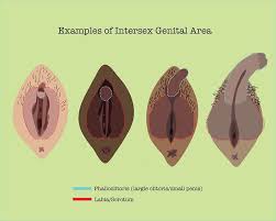 Intersex is a general term used for a variety of conditions in which a person is born with a sexual anatomy that doesn't seem to fit the typical. Intersex Anatomy Anatomy Drawing Diagram