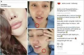 Atau ada salah satu temen yang mempunyai tahi lalat di hidungnya? Tahi Lalat Di Leher Jadi Bukti Lucinta Luna Memang Operasi Ganti Kelamin