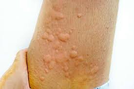 Penanganan kasus gigitan hewan berbisa. Mengenali Jenis Gigitan Tungau Dan Obatnya Alodokter