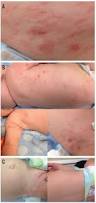 Image result for scabies human children