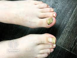 Image result for Onychotillomania feet