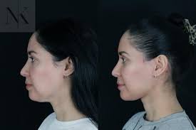 Chin Implant Before and After Photo Gallery