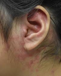 Image result for Photodermatitis