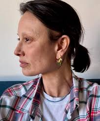 Melanie Sykes reveals devastating health battle while showing bald spot