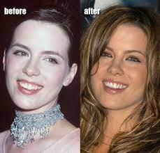 I think you can chalk it up to several changes: Kate Beckinsale Plastic Surgery Before And After Photos Kate Beckinsale Plastic Surgery Plastic Surgery Nose Job