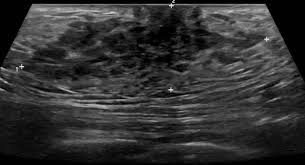 As the cancer progresses, signs and symptoms can include a. Gynecomastia Radiology Case Radiopaedia Org