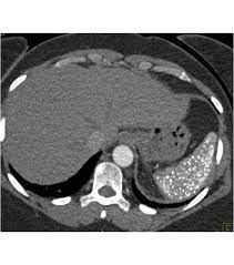 Splenic Granulomatous Disease Spleen Case Studies Ctisus Ct Scanning