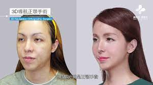 織田紀香臉部女性柔化手術-謝明吉醫師案例分享- YouTube
