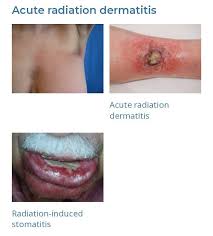 Image result for Radiation Dermatitis