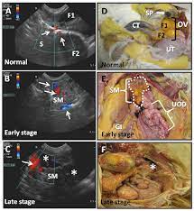 Ovarian cancer screening is not actually recommended for people at an average risk of developing the condition. Selection Of Hens With Normal Ovaries Or Ovarian Tumors Using A C Download Scientific Diagram