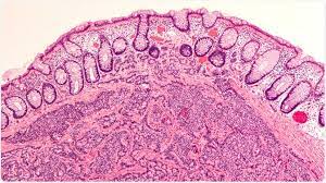 O carcinoide do pulmão é uma lesão neoplásia maligna primária relativamente rara que pertence à classe dos tumores neuroendócrinos do pulmão, que segundo a oms, inclui o carcinoide típico, carcinoide atípico, carcinoma de. Sinais E Sintomas Carcinoid Do Tumor