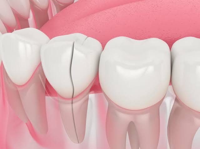 Is It Normal to Have Small Cracks in My Teeth? Revealed