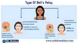 The reported annual incidence varies in different parts of the world with estimates varying between 11 and 40 per 100 000 people. Bells Palsy Homeopathic Treatment Idiopathic Facial Paralysis