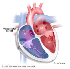 Image result for Atrial Septal Defect