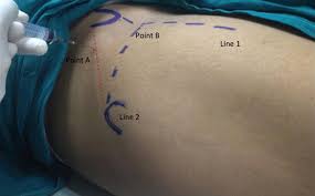 Image result for Hip Injection