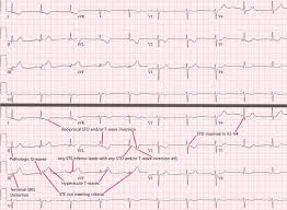 Aims recognise the ecg patterns which occur in nstemi focus on those which occur most commonly difficult ecg scenarios. Accuracy Of Omi Ecg Findings Versus Stemi Criteria For Diagnosis Of Acute Coronary Occlusion Myocardial Infarction Sciencedirect