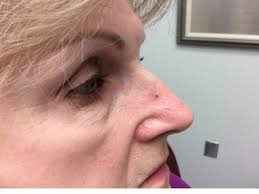 Image result for skin cancer on nose pimple