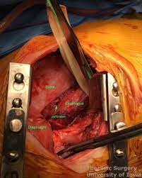 Mar 13, 2015 · enhanced recovery (er) pathways have become the established standard of care in many areas of gastrointestinal (gi) surgery. Esophagectomy Three Field Mckeown Laparotomy And Right Thoracoscopy Thoracotomy With Cervical Anastomosis Iowa Head And Neck Protocols