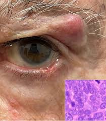 Image result for Merkel Cell Carcinoma