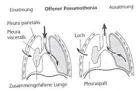 Tuberculous pneumothorax is a severe pathology which requires other anti tuberculor drugs eventually surgical treatment for drainage and lung decortications to improve their prognosis. Https Publikationen Uni Tuebingen De Xmlui Bitstream Handle 10900 46063 Pdf Dissertationbibliotheksversion Pdf Sequence 1 Isallowed Y