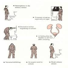 Benign Prostatic Hyperplasia Bph Benign Prostatic Hyperplasia Enlarged Prostate Homeopathy