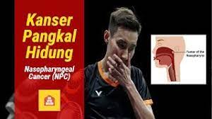 Kanser serviks adalah kanser ketiga paling tinggi dihidapi wanita di negara ini membabitkan 12 peratus daripada semua kanser yang dihidapi wanita selepas kanser payudara dan usus besar. Kanser Pangkal Hidung Nasopharyngeal Cancer Npc Youtube