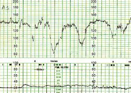 Image result for Variable Deceleration