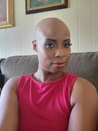 Embracing baldness and alopecia