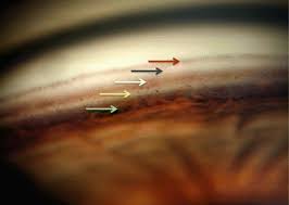 Image result for Gonioscopy