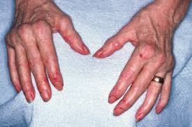 Illustrated Rheumatoid Arthritis Gponline