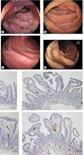 Image result for Intestinal Enteropathy